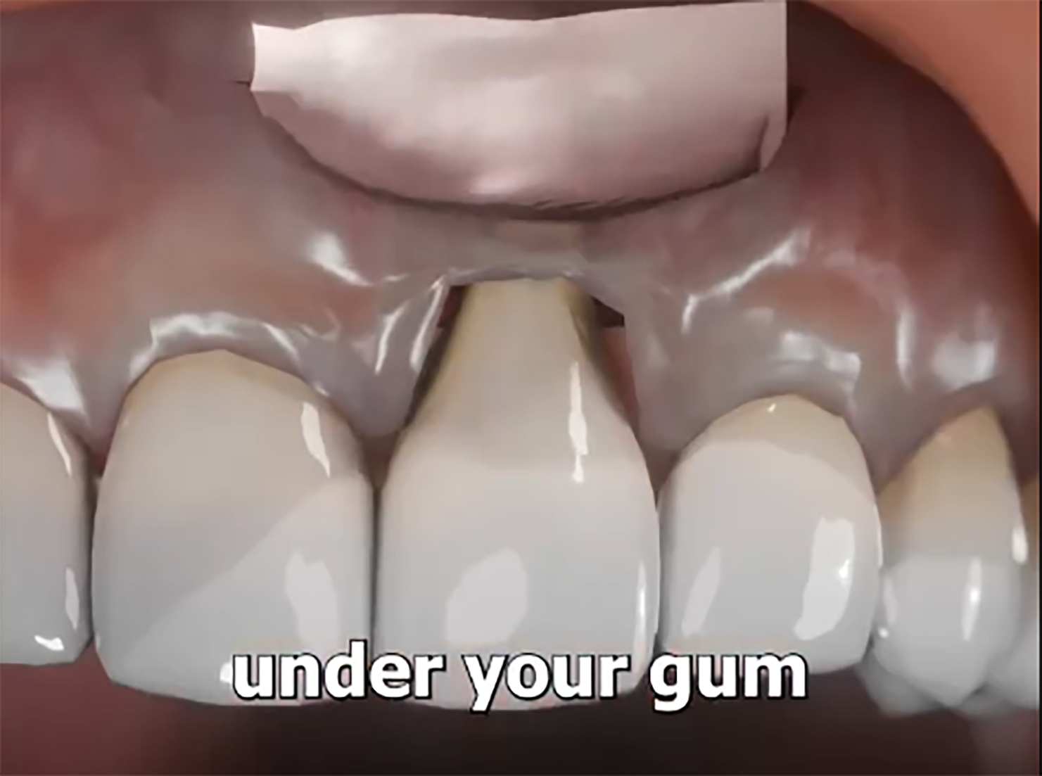  Explore-the-role-of-dead-skin-in-developing-new-gingiva,-advancing-periodontal-therapy-and-soft-tissue-reconstruction-for-dental-specialists.