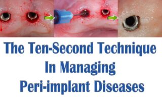 Ten Second Technique In Managing Peri-implant Diseases