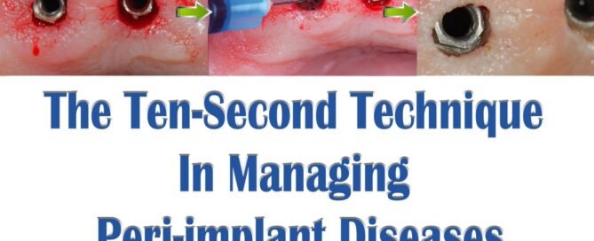 Ten Second Technique In Managing Peri-implant Diseases