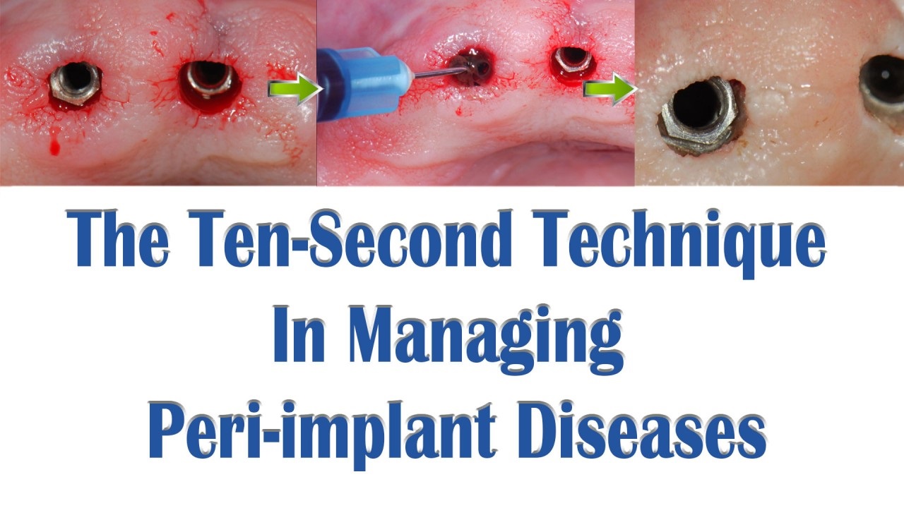Ten Second Technique In Managing Peri-implant Diseases
