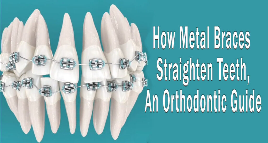 How Metal Braces Straighten Teeth, An Orthodontic Guide