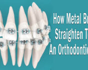 How Metal Braces Straighten Teeth, An Orthodontic Guide