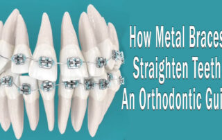 How Metal Braces Straighten Teeth, An Orthodontic Guide