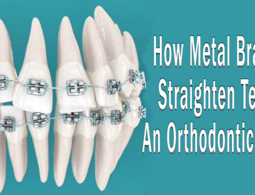 How Metal Braces Straighten Teeth: An Orthodontic Guide