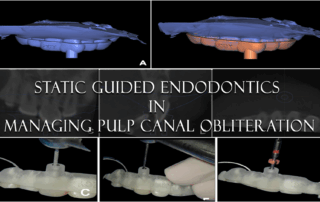 Static guided endodontics in managing pulp canal obliteration