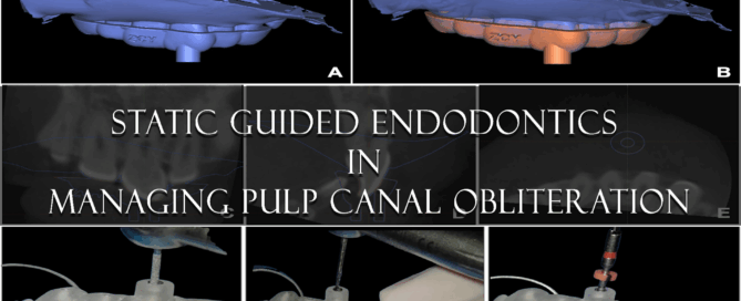 Static guided endodontics in managing pulp canal obliteration
