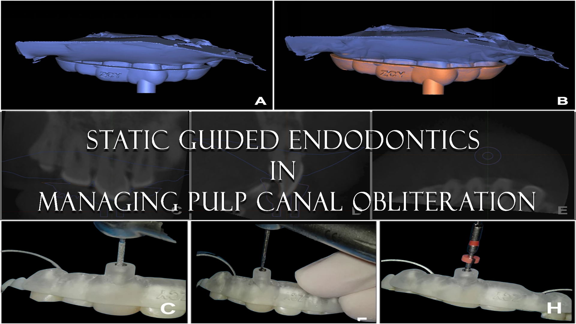 Static guided endodontics in managing pulp canal obliteration