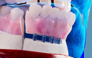 Autogenous Tibial Bone Grafts for Mandibular Reconstruction