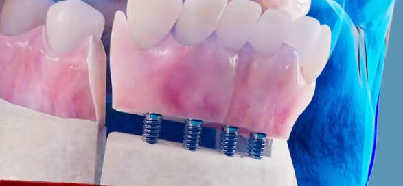 Autogenous Tibial Bone Grafts for Mandibular Reconstruction