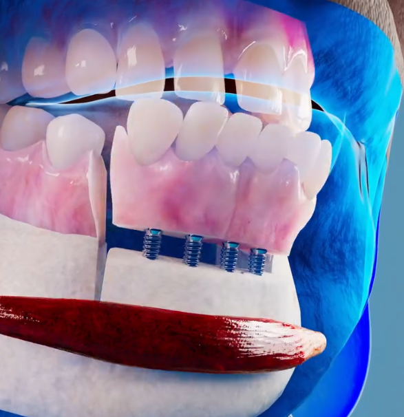 Autogenous Tibial Bone Grafts for Mandibular Reconstruction