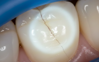 Cracked Tooth Diagnosis in 2025 From Clinical Tests to CBCT