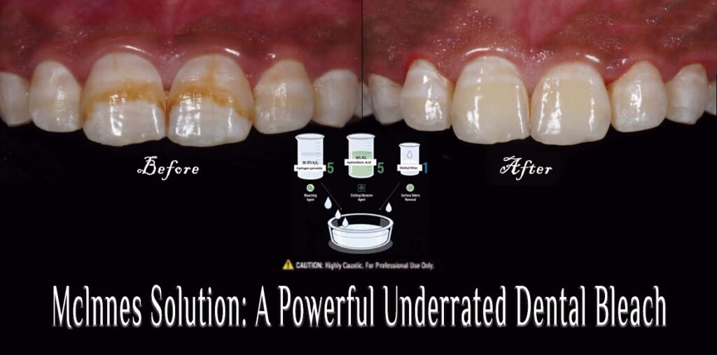 Mclnnes Solution: A Powerful Underrated Dental Bleach