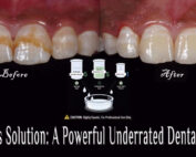 Mclnnes Solution: A Powerful Underrated Dental Bleach
