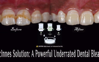 Mclnnes Solution: A Powerful Underrated Dental Bleach