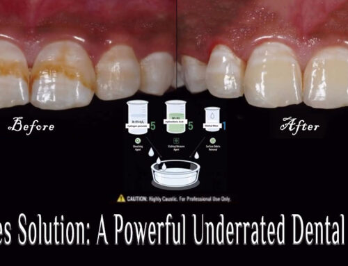 Mclnnes Solution: A Powerful Underrated Dental Bleach