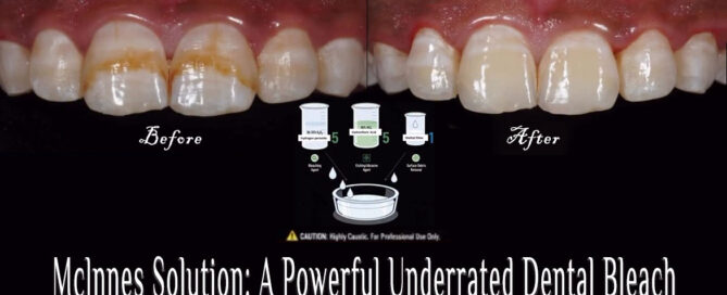 Mclnnes Solution: A Powerful Underrated Dental Bleach