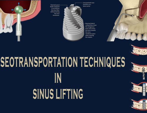 The Osseotransportation Techniques in Sinus Lifting