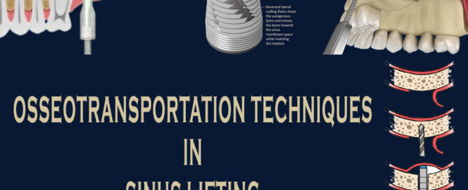 Osseotransportation Techniques in Sinus Lifting