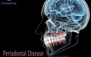 Periodontal Disease and Brain Aging: A New Study