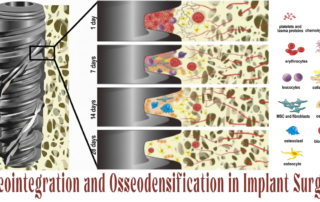 Osseointegration and Osseodensification in Implant Surgery