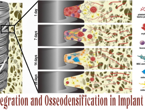 Osseointegration and Osseodensification in Implant Surgery