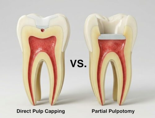 Pulp Capping VS. Partial Pulpotomy in Reversible Pulpitis