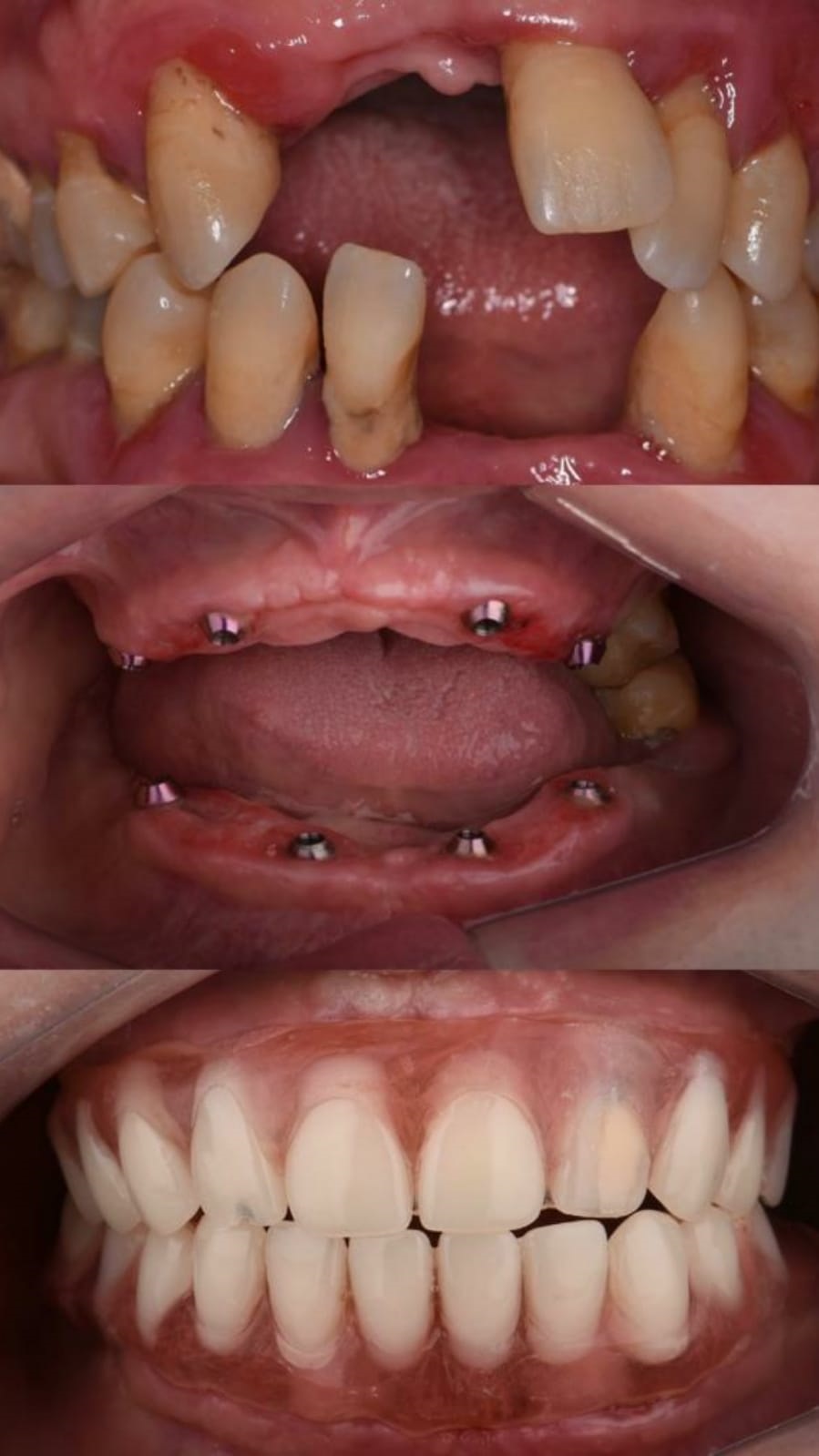 Dentinova Dental Clinic Hurghada full mouth rehabilitation
