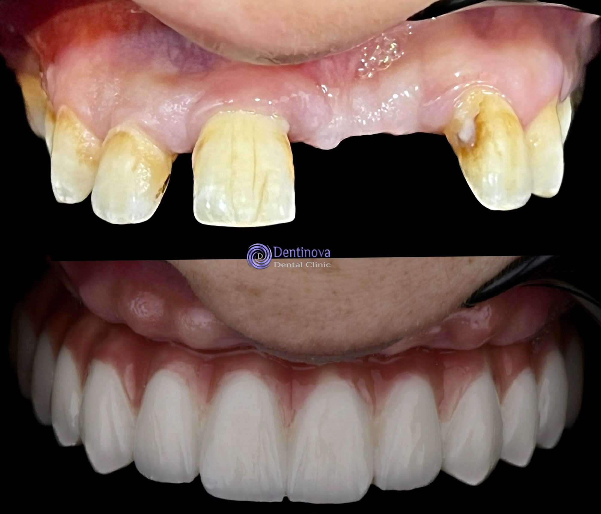 Dentinova Dental Clinic Hurghada Full Arch Restoration 2 Dentinova Dental Clinic Hurghada Full Arch Restoration