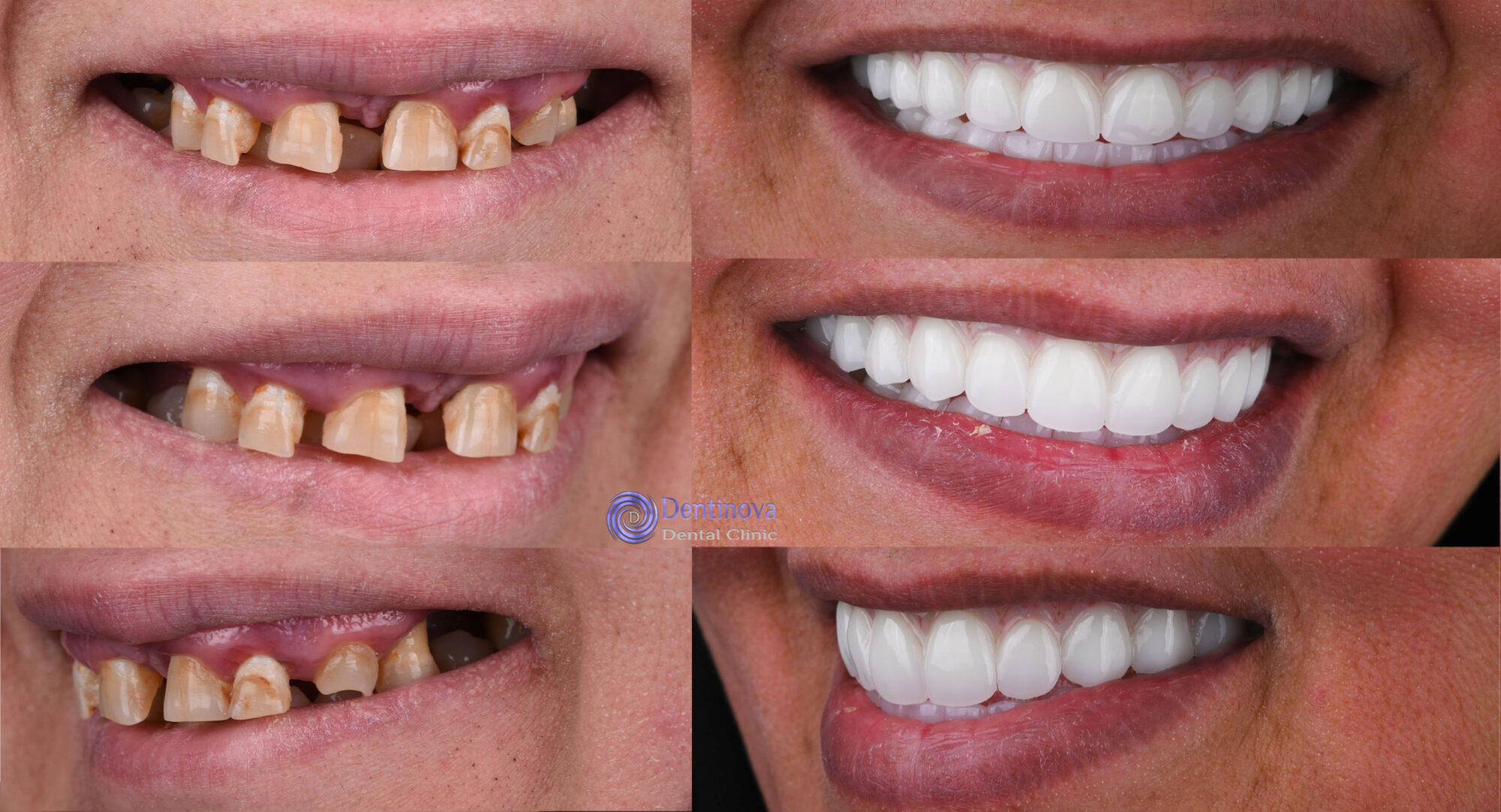 Dentinova Dental Clinic Hurghada Full Arch Restoration 3 Dentinova Dental Clinic Hurghada Full Arch Restoration