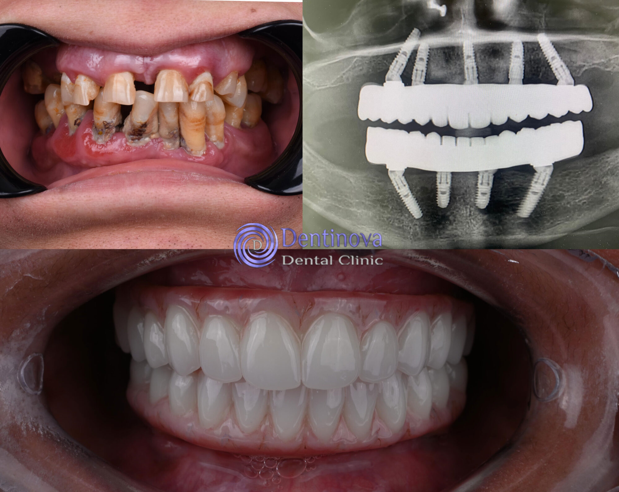 Dentinova Dental Clinic Hurghada Full Arch Restoration Dentinova Dental Clinic Hurghada Full Arch Restoration