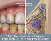 A Link Discovered Between Periodontal Disease and Breast Cancer