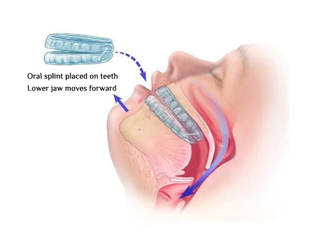 Illustration of the use of an oral appliance that keeps the airway open