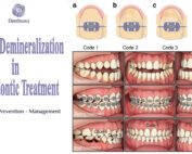 Enamel Demineralization in Orthodontic Treatment
