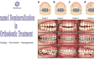 Enamel Demineralization in Orthodontic Treatment