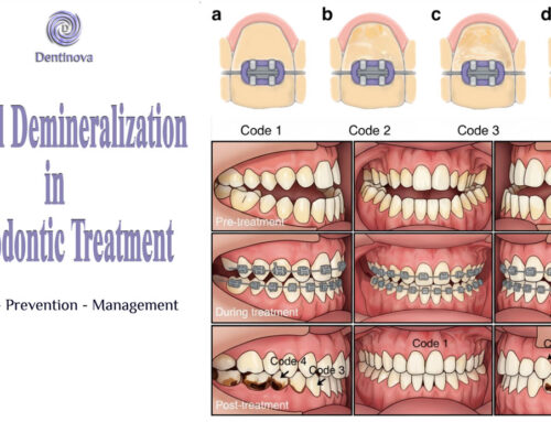 Enamel Demineralization in Orthodontic Treatment