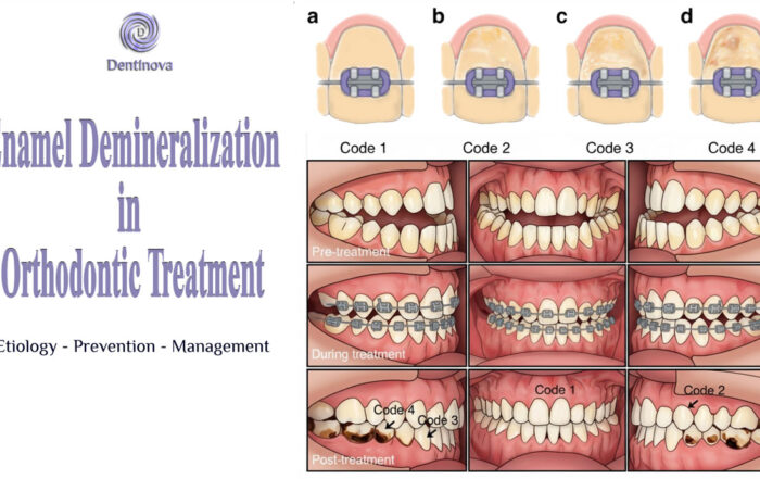 Enamel Demineralization in Orthodontic Treatment