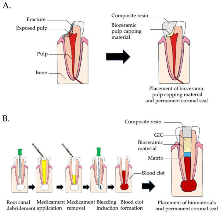 Endodontic Regeneration Therapy Strategies & Solutions