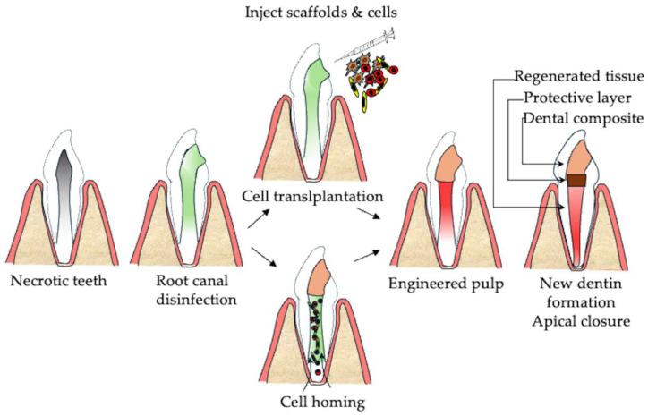 Endodontic Regeneration Therapy Strategies & Solutions