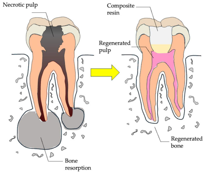 Endodontic Regeneration Therapy Strategies & Solutions