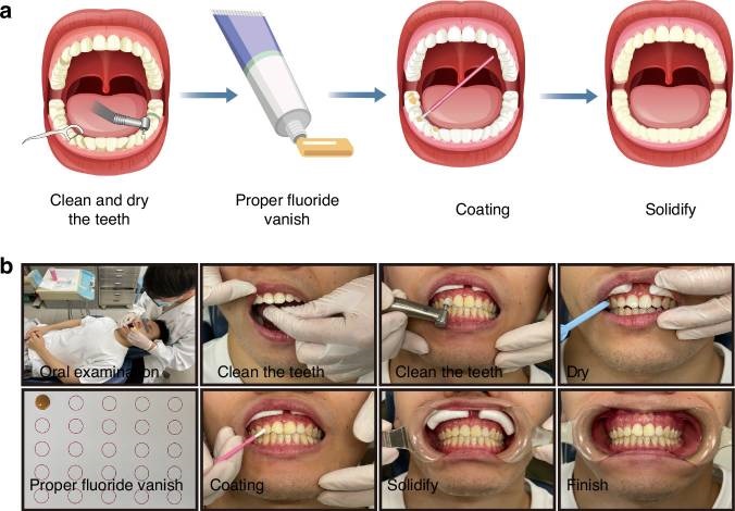 Flouride Application for Enamel Demineralization prevention