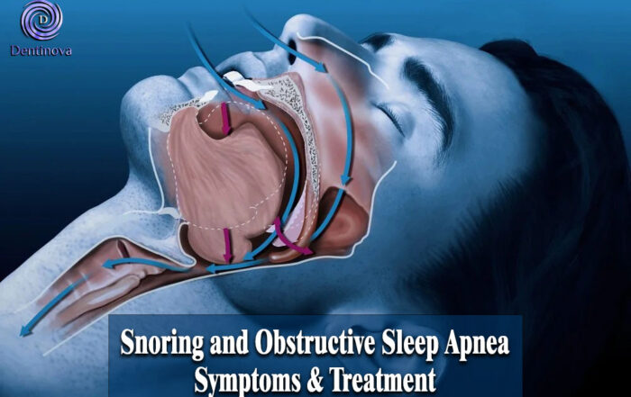 Snoring and Obstructive Sleep Apnea: Symptoms & Treatment
