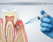 Treating Periodontal Disease with Dental Stem Cell Injection