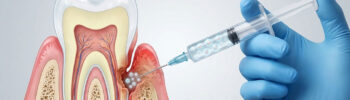 Treating Periodontal Disease with Dental Stem Cell Injection