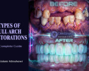 Types of Full Arch Restorations: A Complete Guide