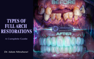 Types of Full Arch Restorations: A Complete Guide