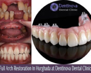 Full Arch Restoration in Hurghada at Dentinova Dental Clinic