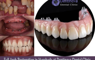 Full Arch Restoration in Hurghada at Dentinova Dental Clinic