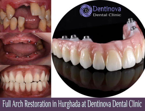Full Arch Restoration in Hurghada at Dentinova Dental Clinic