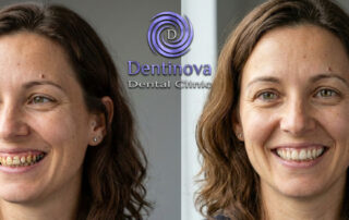 Full Mouth Restoration in Hurghada: What to Expect & When to Consider It