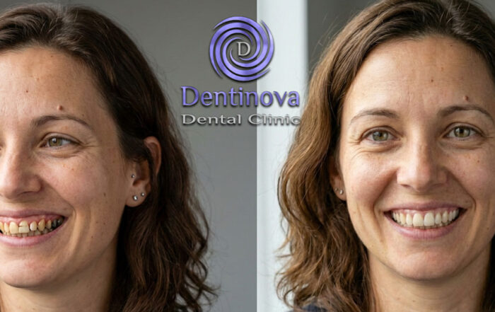 Full Mouth Restoration in Hurghada: What to Expect & When to Consider It
